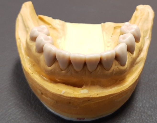 Wax-up – CAD/CAM Център Плевен